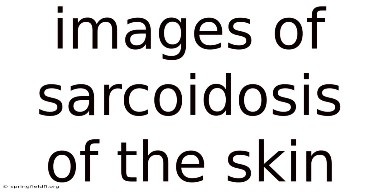 Images Of Sarcoidosis Of The Skin
