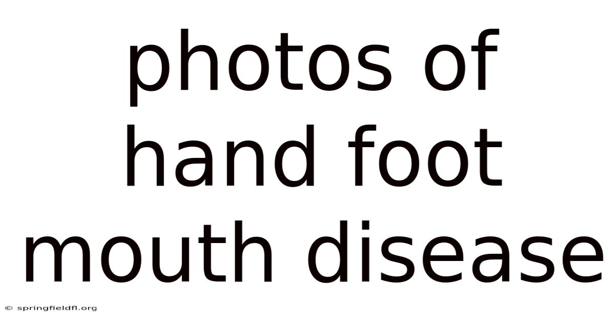 Photos Of Hand Foot Mouth Disease