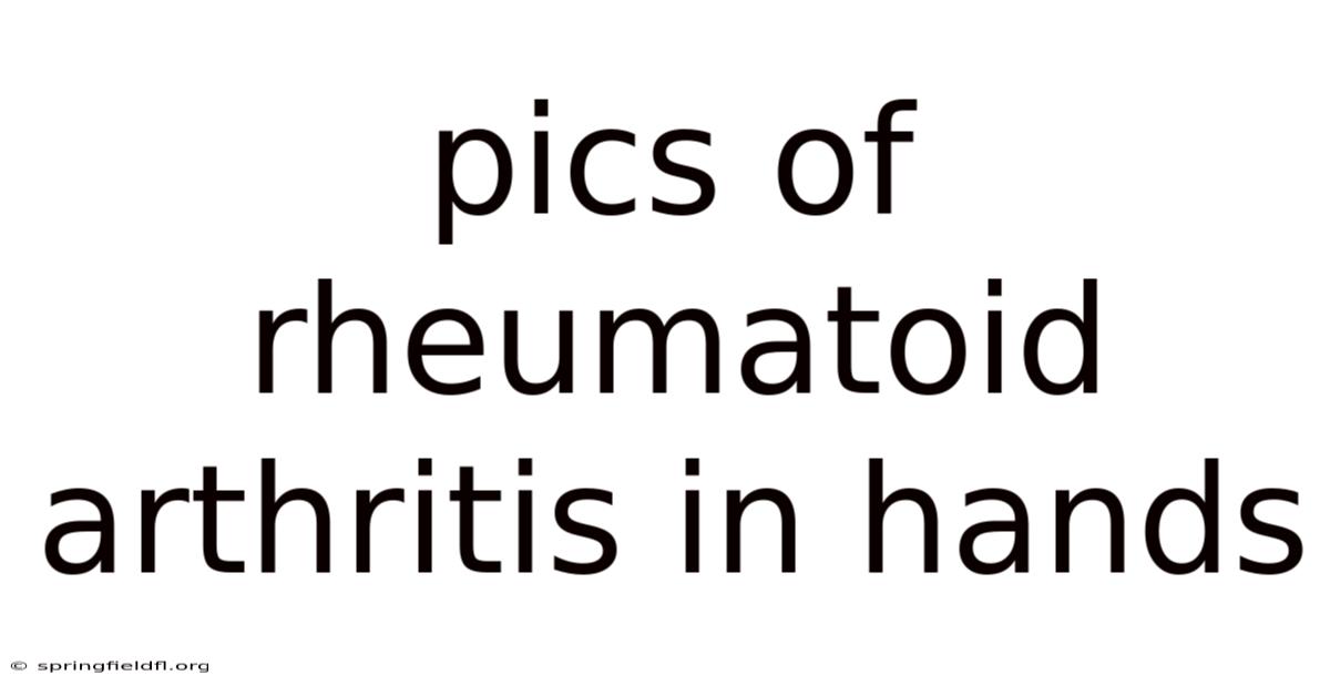 Pics Of Rheumatoid Arthritis In Hands