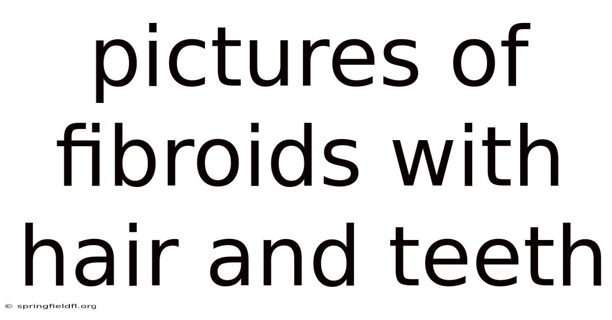 Pictures Of Fibroids With Hair And Teeth