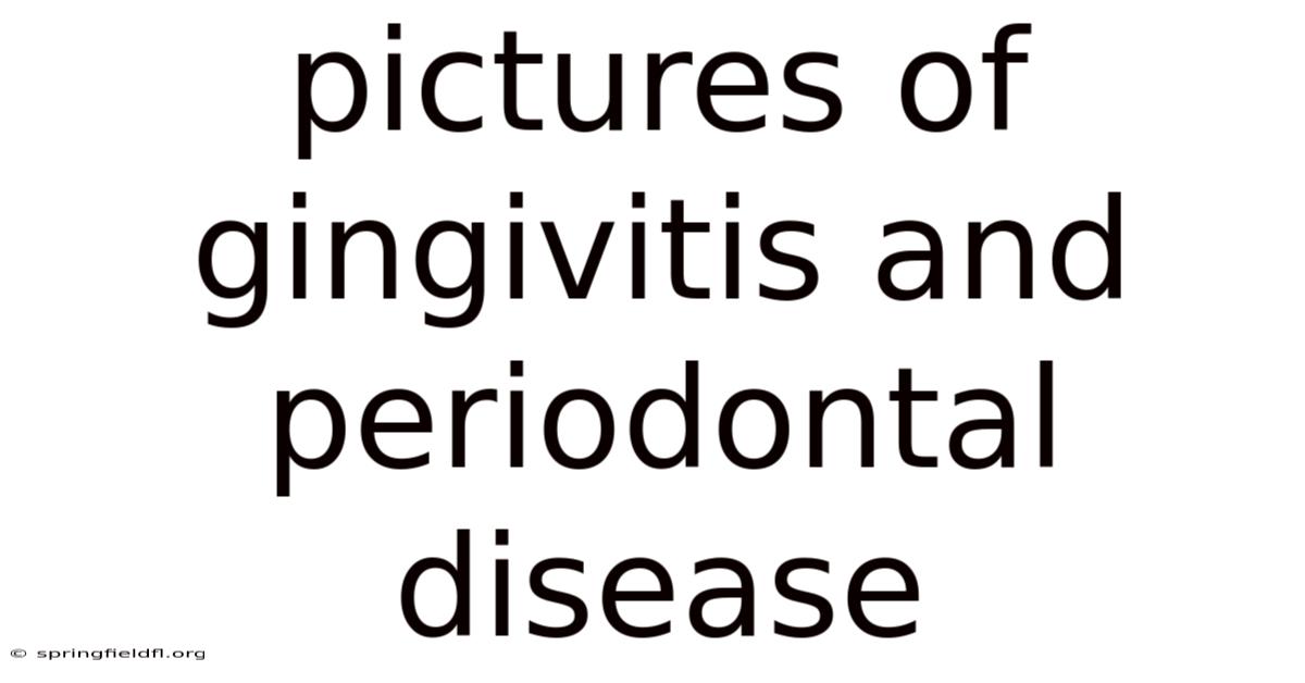 Pictures Of Gingivitis And Periodontal Disease
